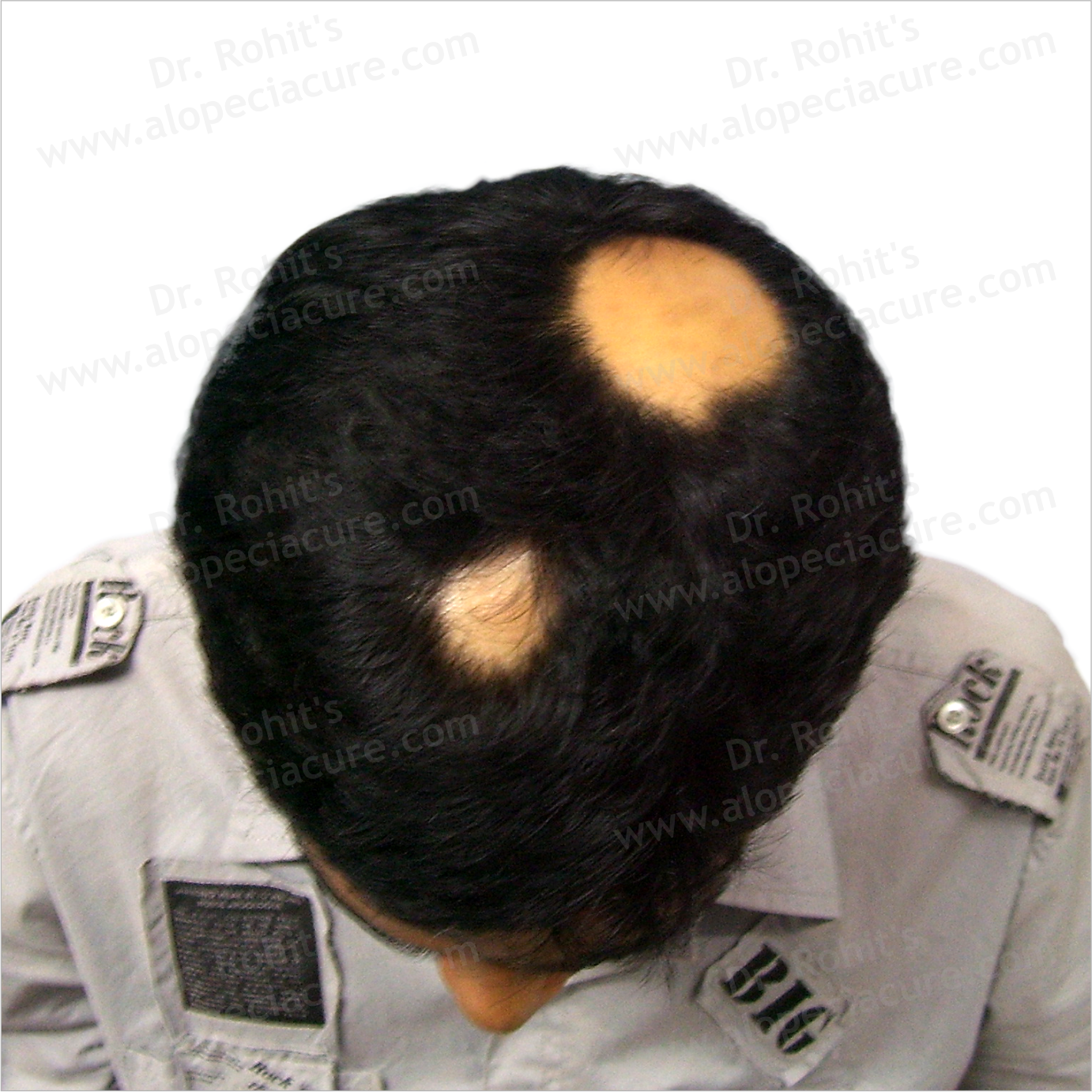 Newly diagnosed with Alopecia Areata